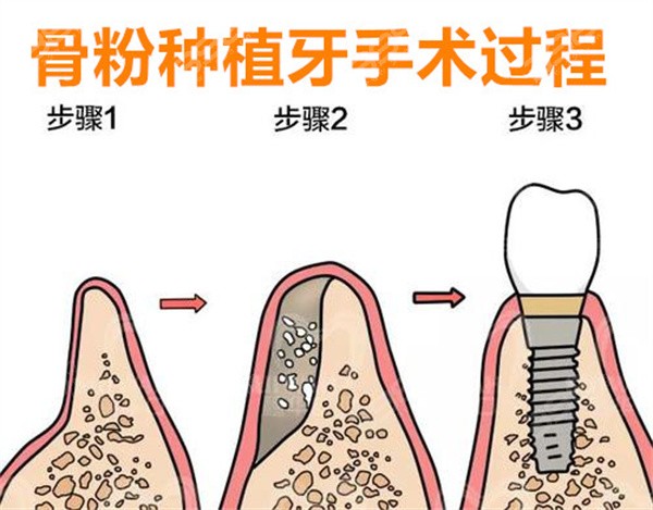 种植牙最新资讯速递